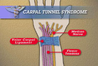 Carpal Tunnel Syndrome