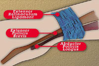 DeQuervain's Disease