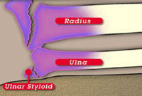 Radius & Ulna Fracture