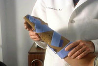 Splinting of DeQuervain's Disease