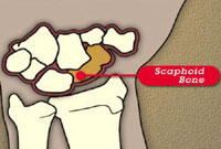 Scaphoid Bone