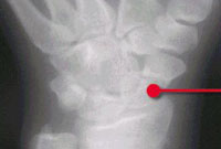 Scaphoid Bone