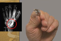 Titanium Metal Implant