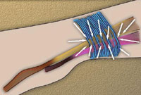 DeQuervain's Disease Treatment